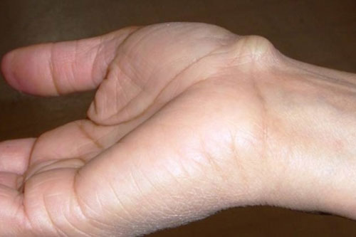 Thấy tay có dấu hiệu này hãy đi khám ngay đừng chủ quan vì chắc chắn bạn sẽ hối hận