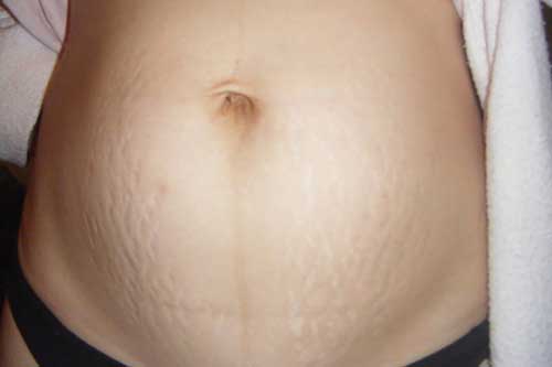 Khắc phục rạn da khi mang thai và sau sinh hiệu quả phụ nữ nên biết