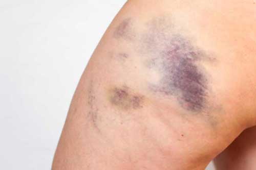 7 nguyên nhân phổ biến gây các vết bầm tím trên cơ thể