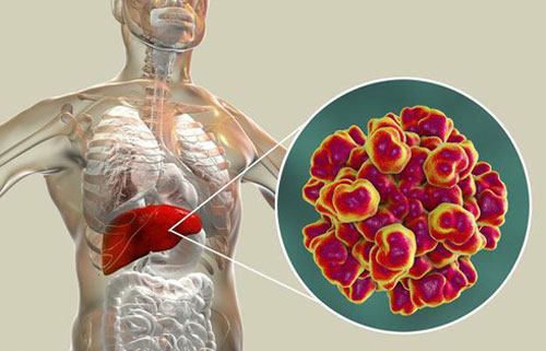Sáu triệu chứng cảnh báo gan suy yếu, làm ngay ba điều sau để thải độc