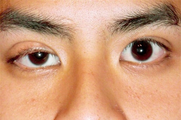 Các căn bệnh ẩn sau những dấu hiệu bất thường của mắt