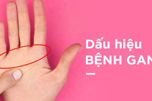 Những dấu hiệu cảnh báo gan nhiễm bệnh, bạn nên đi khám sớm để bảo vệ sức khỏe