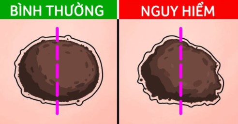 5 tín hiệu từ nốt ruồi cảnh báo ung thư đang tiềm ẩn dưới làn da mà bạn cần chú ý