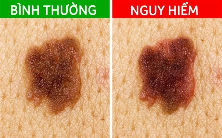 5 tín hiệu từ nốt ruồi cảnh báo ung thư đang tiềm ẩn dưới làn da