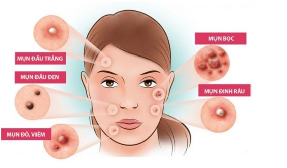 Trị mụn tại nhà đơn giản, hiệu quả mà chỉ cần mất vài phút mỗi ngày