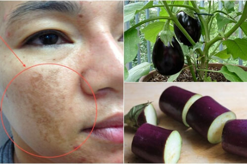 Chẳng tốn tiền triệu đi bắn laser, chỉ cần làm theo cách này nám, tàn nhang tự động biến mất vĩnh viễn