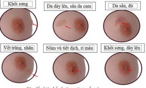 Cách sờ nắn đơn giản giúp phát hiện sớm ung thư vú mà bạn nên biết