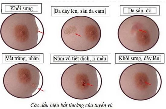 Cách sờ nắn đơn giản phát hiện sớm ung thư vú