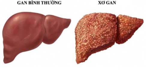 Có 4 triệu chứng này khi uống rượu, bạn cần đi khám xơ gan ngay lập tức