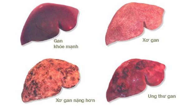 Muốn tránh ung thư gan, đây là 4 điều bạn cần làm ngay lập tức