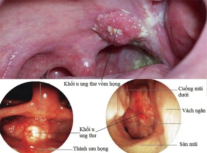 Ung thư vòm họng hay bị nhầm với cảm cúm: BS nhắc có dấu hiệu này 1 tuần không khỏi thì phải khám - Ảnh 2.