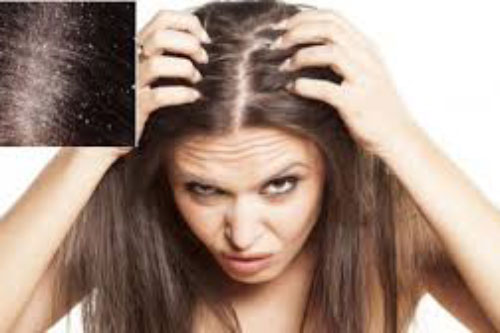 Dùng "thần dược" siêu rẻ này để gội đầu đảm bảo hết sạch 90% gàu trong lần gội đầu tiên