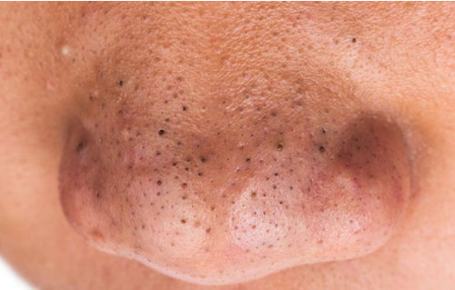 3 bộ phận này trên cơ thể ngày càng 'đen', báo hiệu gan đang suy yếu