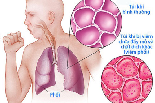 Dấu hiệu ‘ba đen, hai đau’ cảnh báo phổi đang tổn thương nặng nề, cần đi gặp bác sĩ ngay lập tức