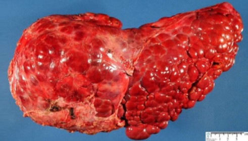 4 bi&#x1EC3;u hi&#x1EC7;n nh&#x1ECF; tr&#xEA;n c&#x1A1; th&#x1EC3; b&#x1EA1;n c&#x1EA3;nh b&#xE1;o gan ng&#xE0;y c&#xE0;ng y&#x1EBF;u &#x1EDB;t, suy nh&#x1B0;&#x1EE3;c