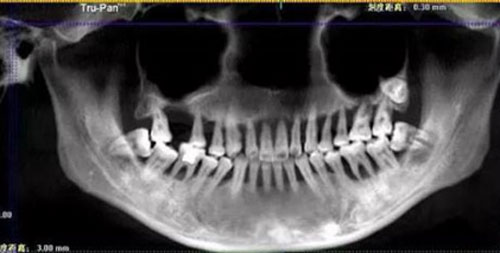 Cô gái 28 tuổi rụng răng, móm mém như cụ bà 80 vì thói quen xấu này