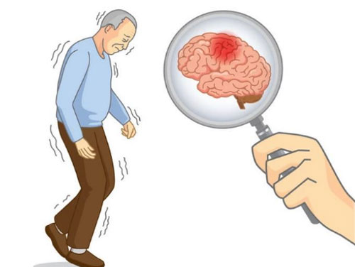 3 đặc điểm xuất hiện khi thức dậy vào buổi sáng cảnh báo bệnh nhồi máu não