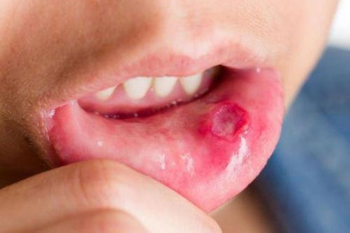 Cách chữa nhiệt miệng đơn giản hiệu quả cực nhanh