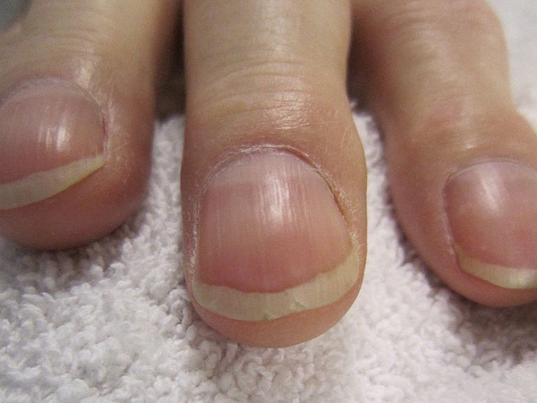 5 triệu chứng của ung thư phổi rất nhiều người không biết