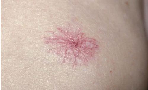 3 biến đổi trên da cảnh báo bệnh ung thư gan