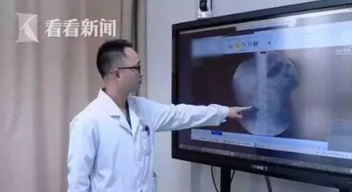 Bé trai 9 tuổi có 56 viên sỏi trong thận vì thói quen này