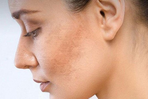 Thói quen sinh hoạt ảnh hưởng như thế nào đến làn da?