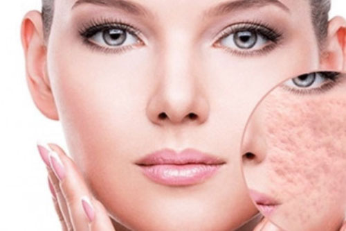 Cách trị các loại sẹo và làm đẹp da đơn giản bằng hành tây