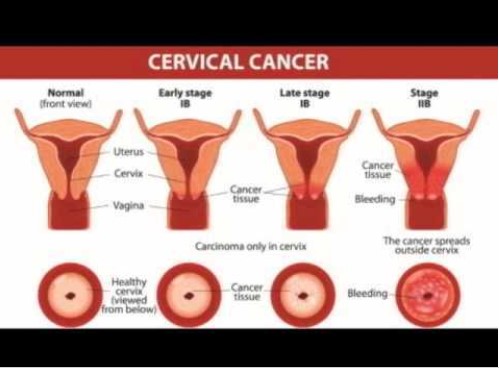 Mách bạn top 5 dấu hiệu ung thư cổ tử cung dễ bị bỏ qua