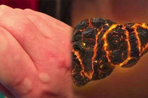 8 biểu hiện chứng tỏ gan đang rất nóng, cần thải độc cơ thể ngay lập tức