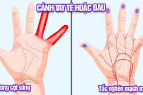 Dấu hiệu bàn tay cảnh báo căn bệnh vô cùng nguy hiểm rất nhiều người Việt vẫn cố tình bỏ qua