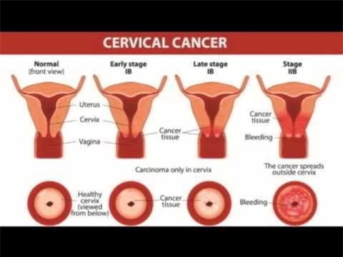5 dấu hiệu ung thư cổ tử cung dễ bị bỏ qua