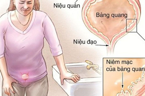 5 dấu hiệu "lạ" xuất hiện khi đi vệ sinh cảnh báo căn bệnh nguy hiểm, hãy đi khám ngay còn kịp