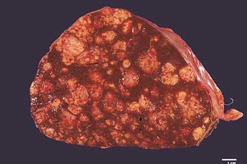 Không phải rượu bia, đây mới là 'sát thủ' gây ung thư gan âm thầm cho người Việt