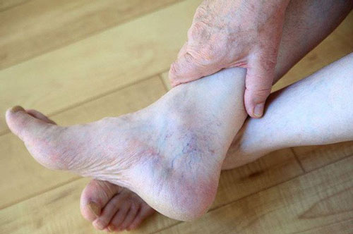 Bàn chân có dấu hiệu này hãy cảnh giác với ung thư gan