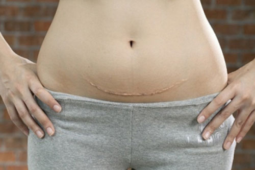 6 điều mẹ trẻ phải biết sau khi sinh mổ