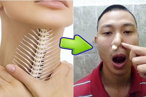 Chớ vội uống giấm nếu bị hóc xương cá, cứ làm theo cách này sẽ khỏi ngay tức khắc