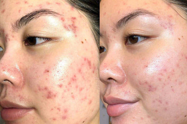 4 sai lầm phổ biến khi skincare nhiều bước khiến da nhanh chóng bị xấu đi