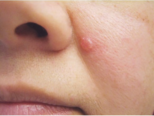 3 dấu hiệu dễ bị bỏ qua giúp bạn phát hiện sớm ung thư da