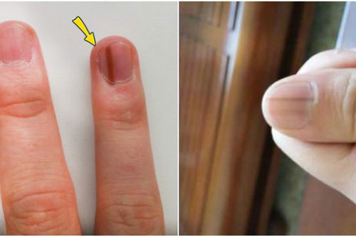 Thấy bàn tay có 1 trong 4 dấu hiệu này: Đi khám ngay vì cơ thể đang cảnh báo bệnh nguy hiểm
