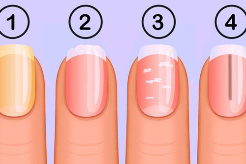4 dấu hiệu lạ ở móng tay báo động bạn bị bệnh tiểu đường, nguy hiểm nhất là số 1
