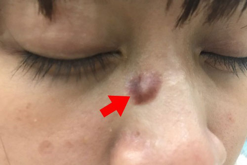 Nhìn vào điểm này trên nốt ruồi, bạn có thể kiểm tra chính xác nguy cơ ung thư hay không