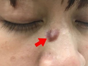 Nhìn vào điểm này trên nốt ruồi, bạn có thể kiểm tra chính xác nguy cơ ung thư hay không