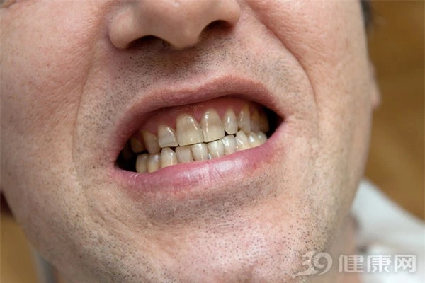 Đại học Harvard công bố kết quả nghiên cứu 20 năm về mối liên hệ giữa răng miệng và ung thư: Người có hàm răng xấu tăng nguy cơ mắc 2 bệnh ung thư - Ảnh 1.