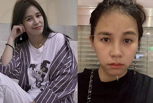 Diễn viên Trần Tiểu Lôi phát hiện bị u não