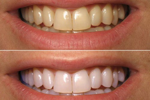 Răng ố vàng tới mấy cũng trắng như đi bọc sứ chỉ với 1 ngàn đồng
