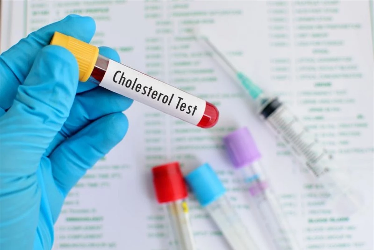 Hàm lượng cholesterol xấu cao: Nhiều minh chứng khoa học đã cho thấy mối liên hệ giữa cholesterol xấu (LDL) và đột quỵ. Tích tụ cholesterol xấu ở thành động mạch có thể làm tăng nguy cơ đột quỵ.