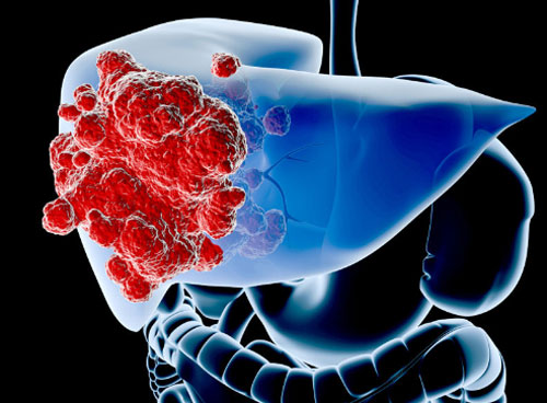Dấu hiệu cảnh báo sớm ung thư gan