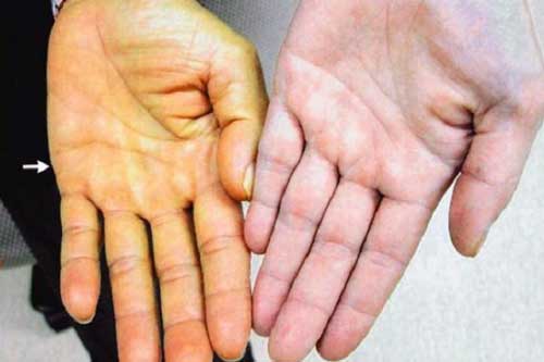 6 dấu hiệu cảnh báo ung thư gan đang tới rất gần bạn