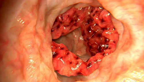 Ung thư đại trực tràng tăng báo động ở người trẻ vì thói quen này