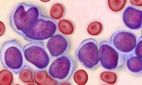 Bệnh ung thư bạch cầu có di truyền không?